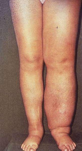 Complications of Lymphedema « Lymphedema Blog