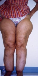 lipedema5