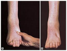 Pitting Edema