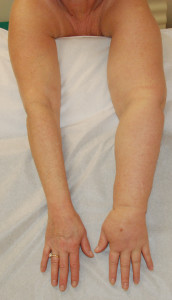 Patient with 7-year history of solid predominant lymphedema of the left arm following breast cancer treatment before SAPL surgery