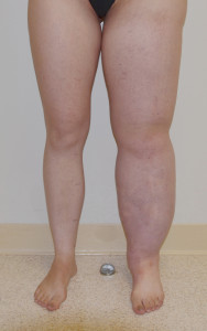 Lymphedema - female - leg